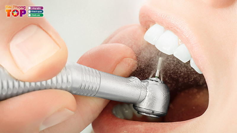 Top-10-dia-chi-cao-voi-rang-hai-phong-an-toan-chat-luong