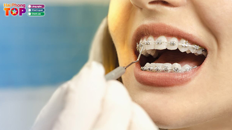 Top-10-dia-chi-nieng-rang-hai-phong-dep-dat-chuan-y-khoa