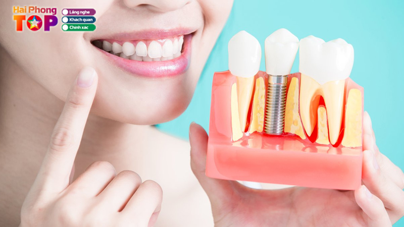 Top-10-dia-chi-trong-rang-implant-tai-hai-phong-dang-tin-cay-nhat
