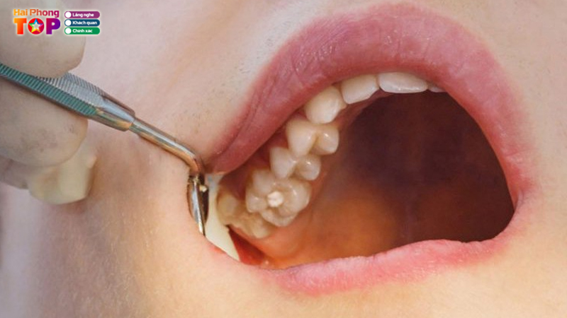 Top-10-dia-chi-nho-rang-khon-hai-phong-uy-tin-an-toan-nhat